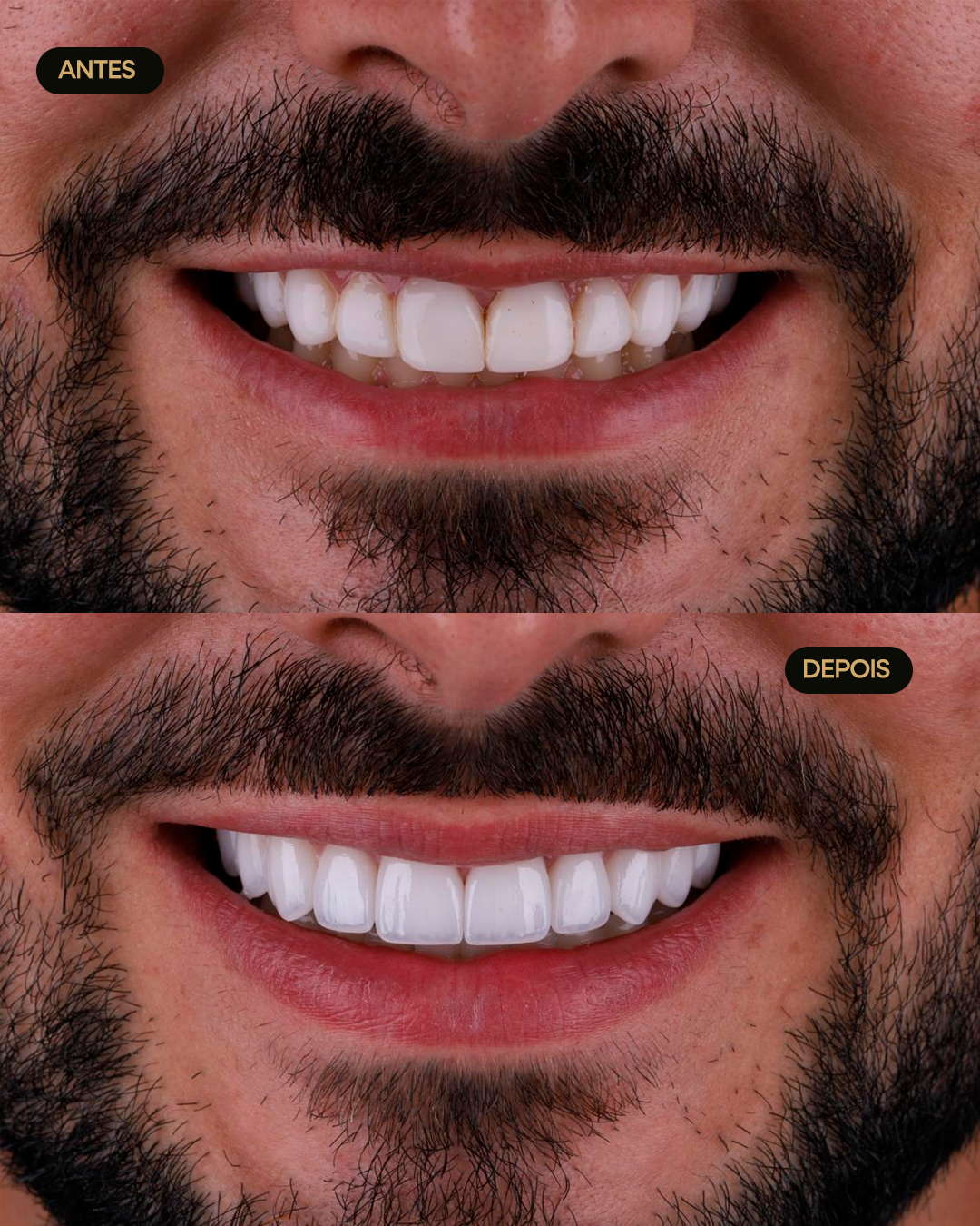 Antes e depois de tratamento estético